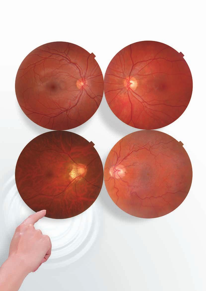 Gesundes Auge Gesundes Auge Hymyopia & Glaucoma Suspicious Innere Grenzmembran