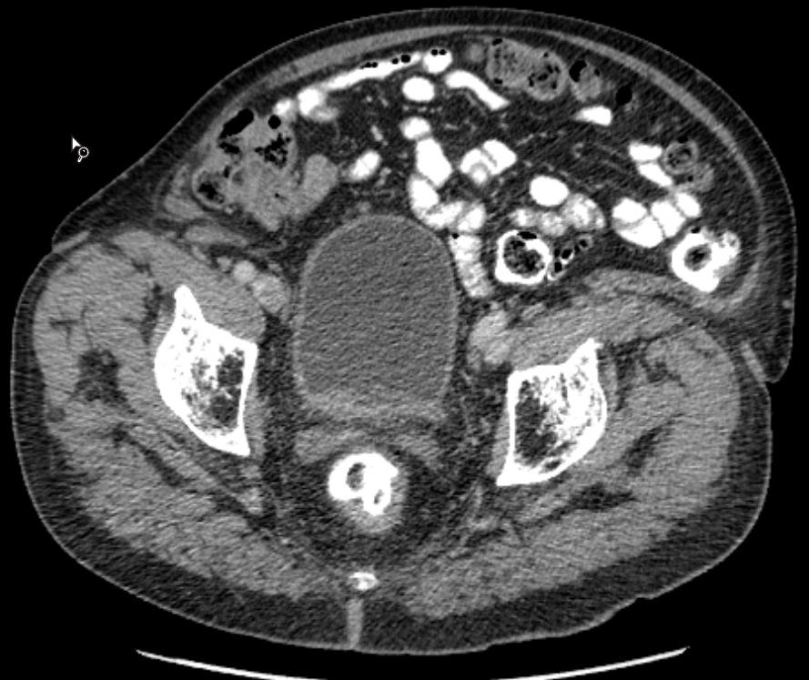 Restaging: MRI! Endoskopie: inkl. Biopsie Complete Responder: wait and see policy (IC!