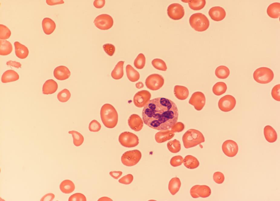 Anämie makrozytär Blutbild: Hb 6,2 g/l, MCV