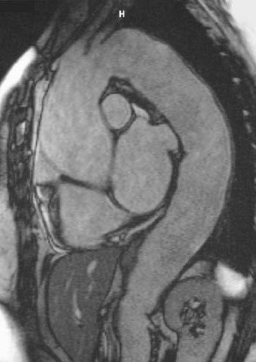 Bei der Patientin wurde zehn Jahre zuvor, auch durch eine Biopsie gesichert, eine Riesenzellarteriitis diagnostiziert.