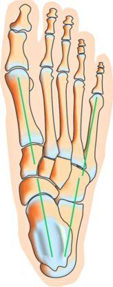 Der Spreizfuß VON LUDWIG SCHWERING Zusammenfassung Der Spreizfuß stellt eine dreidimensionale Strukturstörung des Fußes dar, die geprägt ist von einem Auseinanderweichen der Mittelfußknochen und