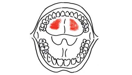 426 Hartmann et al.: Abbildung 5 Das Mundschleimhautbrennen tritt vor allem im Bereich der Zunge und des harten Gaumens auf.