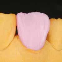 BASIC LINE Schichtung Aufbau der kompletten anatomischen Zahnform mit Dentin, Zurückschneiden des Dentins im incisalen Drittel.