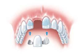 12 Klebebrücke als Provisorium für die Einzelzahnlücke. Im Beratungsgespräch werden alle Ihre Fragen zum Eingriff beantwortet. Schnitt in das Zahnfleisch, der über dem Implantat wieder vernäht wird.
