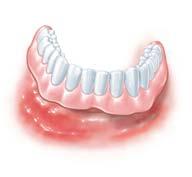 Denn: Original Friadent-Implantate bieten alle Voraussetzungen, damit Ihre neuen Zahnwurzeln bei guter Pflege ein Leben lang halten.