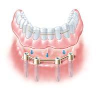 Sprechen Sie Ihren Zahnarzt auf die Möglichkeiten an. Am besten jetzt gleich. Implantate vermeiden diese Qual.