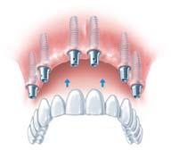 Letzte eigene Zähne kann Ihr Zahnarzt erhalten und harmonisch als Pfeiler in den Zahnersatz integrieren.