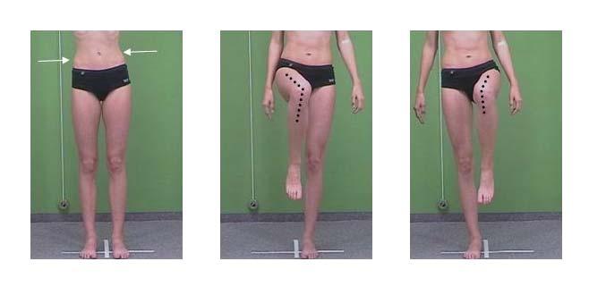 Apophysenreifestörung des Schienbeinhöckers, Schlattersche Krankheit (linkes Bild) und dersitzbeine (rechtes Bild) Beckenrotation, Beckenschiefstand ( ) und Asymmetrie der Beinfunktion bei einer