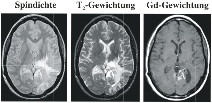 - 7 - In diesem Beispiel sind Schnitte durch ein menschliches Gehirn gezeigt, in denen auf unterschiedliche Weise ein Hirntumor dargestellt wird.