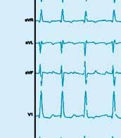 Rechts sind unter Oberflächen-EKG Ableitungen einige intrakardiale elektrische Ableitungen (über Katheter im Herzen) dargestellt, auf denen die schnelle Vorhoffrequenz von 20/min erkennbar ist.