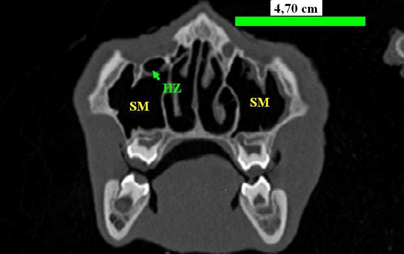 einer linken Hallerzelle sowie ausgewählter Nachbarstrukturen, SM: Sinus maxillaris; HZ: Hallerzelle; Or: Orbita