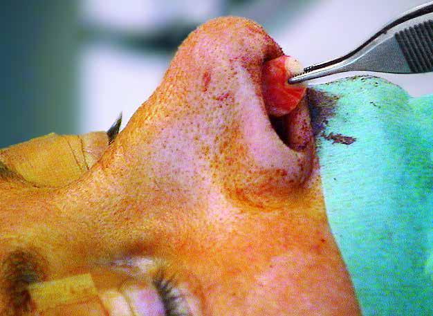 14 Nasenseptumdefektverschluss: Die endonasale erweiterte Brückenlappentechnik 22 Einlage eines Conchaknorpeltransplantates zur Rekonstruktion des knorpeligen Septums.