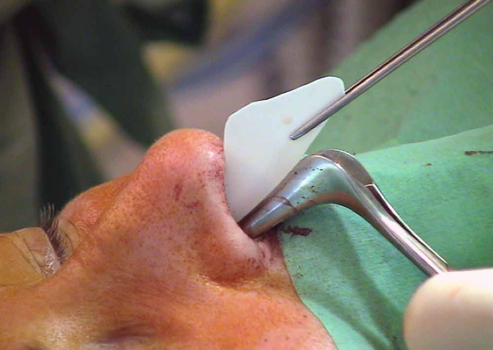 Bei vor operierten Septen findet man dagegen regelmäßig kein hinreichend großes Septumknorpel stück, sodass wir als Knorpeltransplantat am häufigsten Ohrknorpel aus dem Cavum conchae verwenden (Abb.