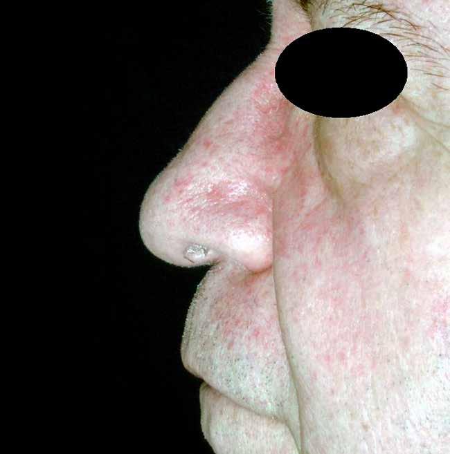 Dazu wird ein autologer Rippenknorpelspan nach der Naht der Schleimhaut defekte zwischen Nasenrücken und