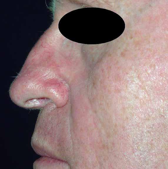 Bei mittelgroßen bis großen Nasenseptumdefekten in Verbindung mit einer Sattelnase, ist in der Regel ein zweizeitiger Eingriff