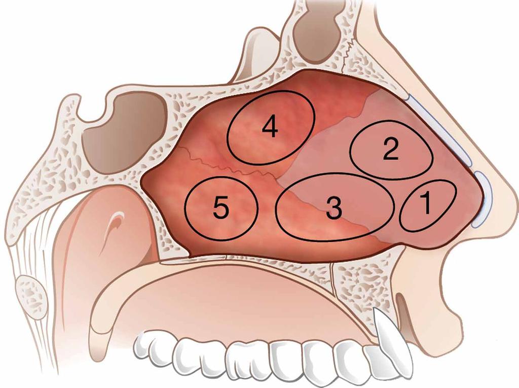 Nasenseptumdefektverschluss: Die endonasale erweiterte Brückenlappentechnik 7 1 Klinische Anatomie des Nasenseptums: 1 = kaudale Septumkante, 2 =