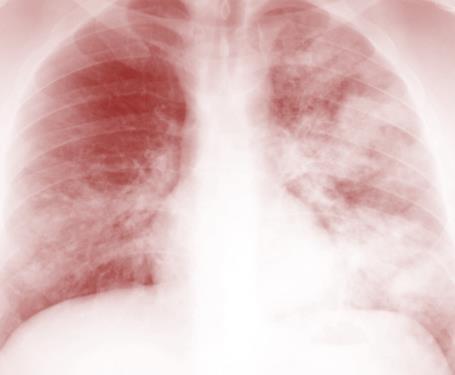14 Pneumonie und COPD Kombination möglich? ICD J44.00 J44.01 J44.02 J44.03 J44.
