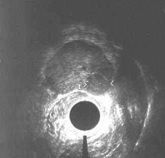 Ultraschalluntersuchung liegt in der gezielten Probenentnahme aus der äußeren Zone der Prostata, da