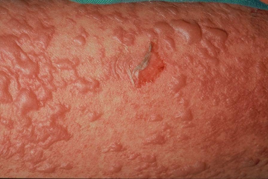 of lesions Papules Macules Extension and