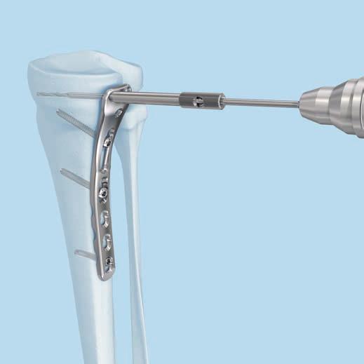 2 Geeignete Schraubenlänge ermitteln und Schraube einbringen 1 Instrumente 314.070 Sechskantschraubenzieher, klein, B 2.5 mm, mit Nut 314.116 Schraubenziehereinsatz Stardrive 3.