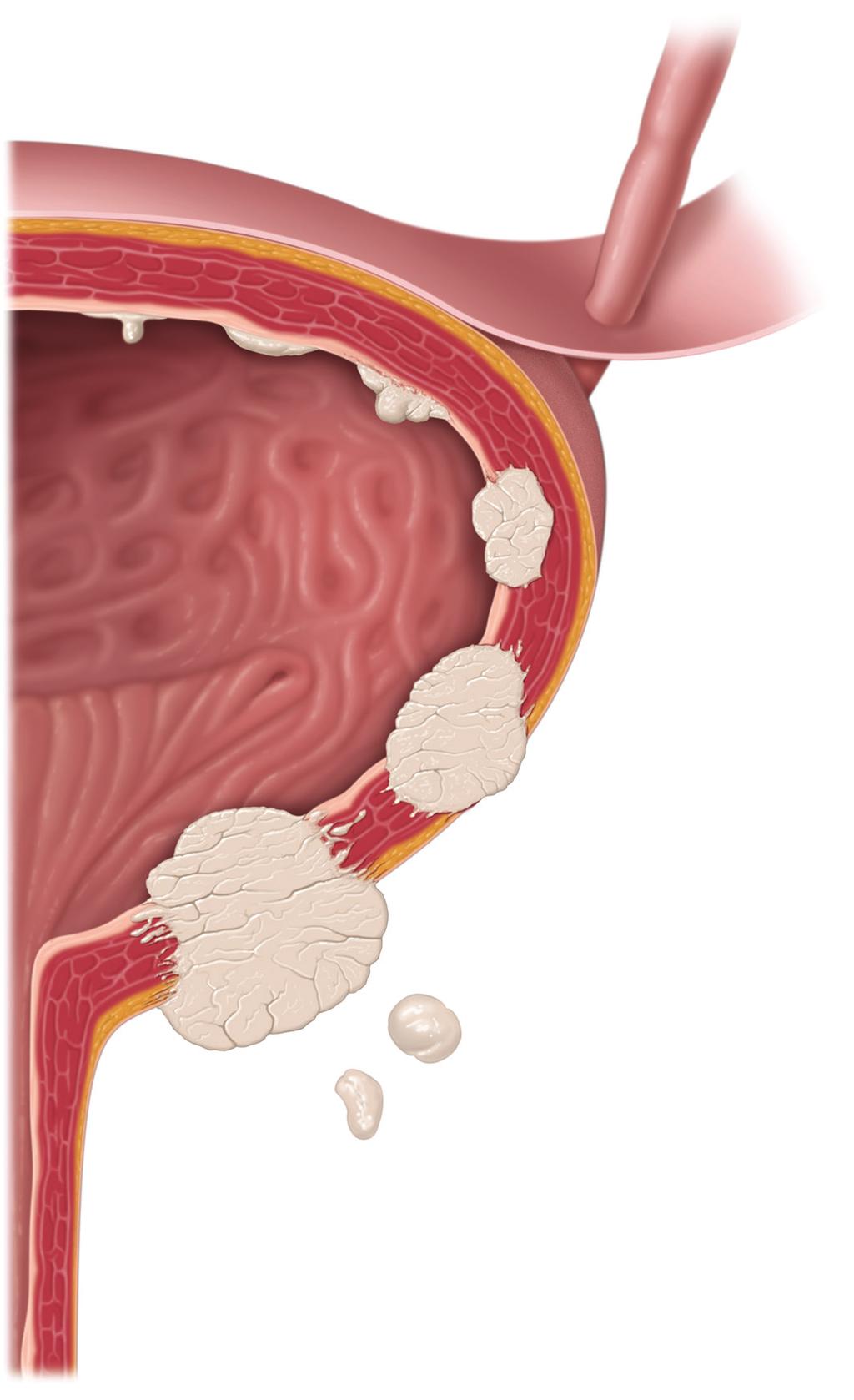 T1-Tumoren haben sich auf das Bindegewebe unter der Blasenschleimhaut ausgebreitet, sind aber nicht in die Muskulatur der Blasenwand eingewachsen.