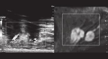 Abb 1: Bildfusion von MRT (linke Bildseite) und Dopplersonografie (rechte Bildseite) mittels elektromagnetischem Tracking Abb 2: Bildfusion von MRT (rechte Bildseite) und Sonoelastografie (linke