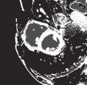 Patient) Literatur: 1. Chetrit M. et al.: The unique role of cardiovascular magnetic resonance imaging in acute myocarditis. F1000Res. 2018 Jul 30;7. 2. Caforio A. et al.: Myocarditis: A Clinical Overview 3.