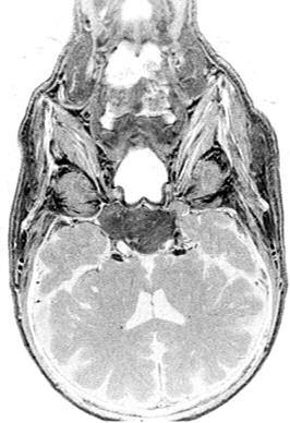 Der Nasopharynx streckt sich von der Schädelbasis bis zum harten Gaumen aus, der Oropharynx hat als kraniale Begrenzung den Nasopharynx und als kaudale Abgrenzung den Hypopharynx/Larynx.