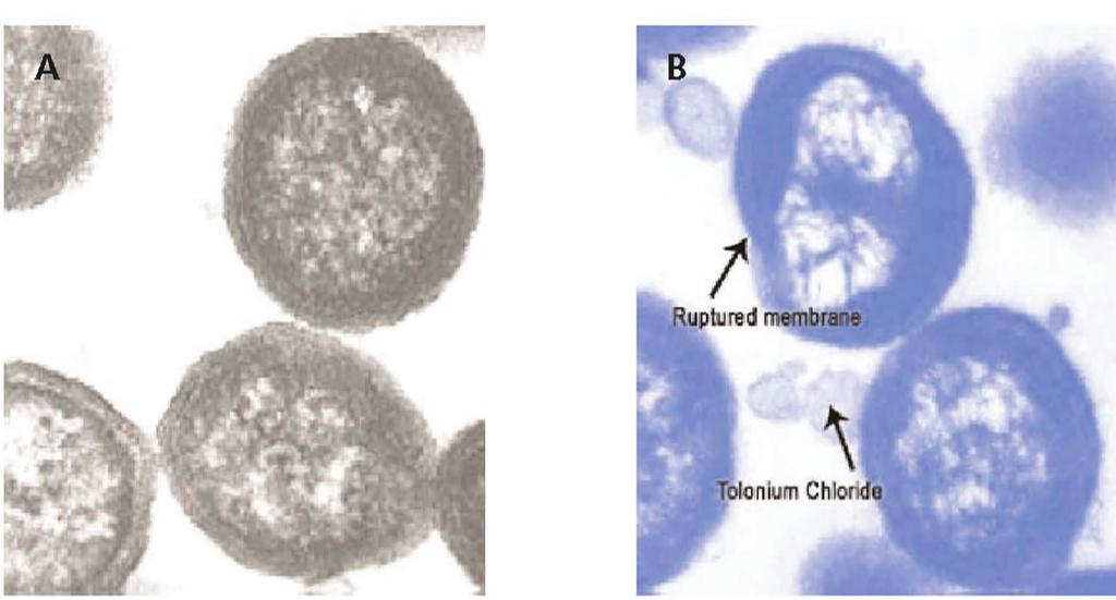 Photo-aktivierte Chemotherapie / Desinfektion PDD / PDT Das Prinzip der Photo-aktivierten Chemotherapie beruht auf dem Abtöten von Bakterien mittels eines Photosensitizers (TBO = Toloniumchlorid),