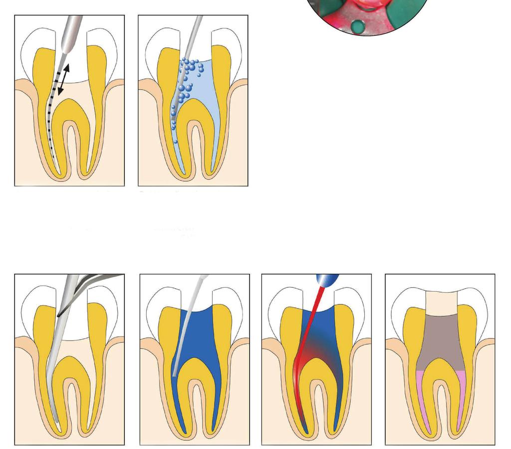 Klinische Anwendung am Beispiel der Wurzelkanal-Desinfektion 1. Zahn trepanieren, isolieren, 2. Wurzelkanäle spülen Wurzelkanäle auf Arbe