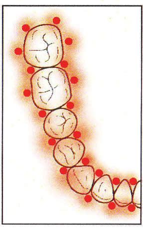 Klinische Anwendung am Beispiel einer persistenten Parodontitis TBO (Toloniumchlorid) + LLLT (Softlaser) Empfehlenswerte Licht-Expositionspunkte (jeweils 60 Sekunden) mittels Softlaser im Zuge