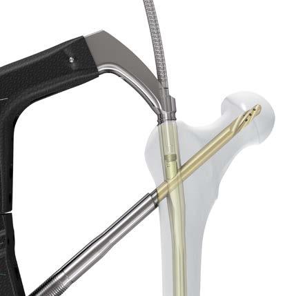 Schieben Sie den 5 mm langen flexiblen Schraubenzieher durch die durchbohrte Verbindungsschraube und den Zielbügel, bis er im hexagonalen Antrieb des Sperrmechanismus sitzt.