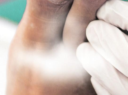 Durch regelmäßig neu eingelegte Tamponaden kann ein Einwachsen der Nägel verhindert