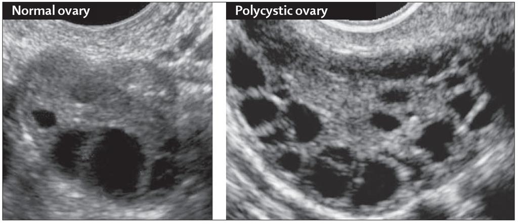 1.2.2.3 Polyzystische Ovarien Der Nachweis soll hier mittels transvaginalen Ultraschalls erfolgen.