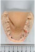 Auch bei Bissspuranalysen können die Charakteristika spezifi scher Zahnformen und -stellungen Rückschlüsse auf den Verursacher ermöglichen. Bissverletzungen zählen zu den (Riss-)Quetschwunden [1].