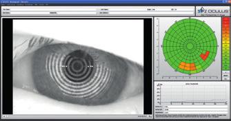 Tränenfilms lt. Definition, gemessen (Abb. 5). RÖTUNGSGRAD DER AUGEN- OBER FLÄCHE Neuerdings ist es möglich die Rötung der Augenoberfläche mittels des Keratograph 5M zu quantifizieren.
