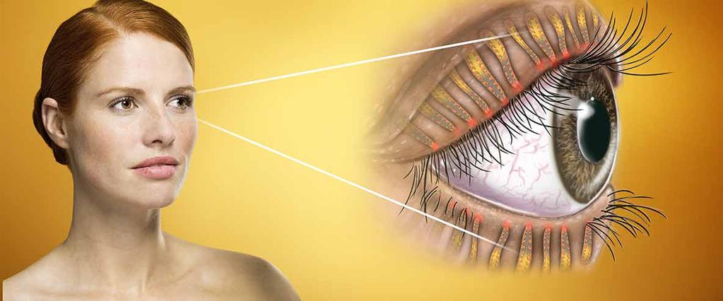 LIDRANDENTZÜNDUNG Die Entstehung ENTSTEHUNG Die Talgdrüsen des Augenlides mit ihren Öffnungen an den Lidrändern, auch Meibomdrüsen genannt, sind ein wichtiger Teil des Schutzapparats der Augen: Sie