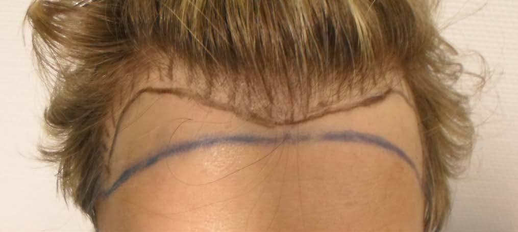 Haarausfall Hautkrankheiten Für den Mann Ernährung Abb. 9: Unrealistische Vorstellung von einem runden Verlauf des Haaransatzes ohne Geheimratsecken (blaue Linie).