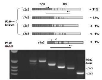 Chronische myeloische Leukämie (CML) Fusionsprotein q34 q11 BCR BCR-ABL ABL ABL-BCR 9 22 9q+ 22q- (Ph) BCR mrna Fusionstranskript ABL ABL