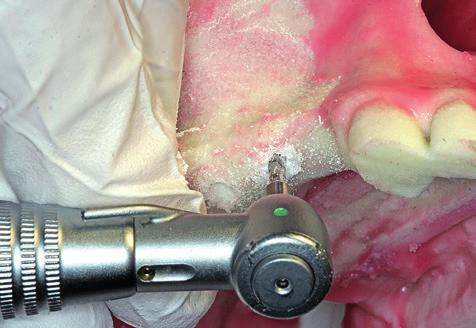 Restknochenangebot im Oberkieferseitenzahngebiet für eine alleinige stabile Implantatinsertion unzureichend ist.