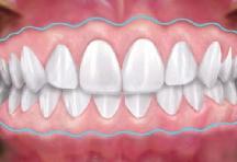 Ungenügend befestigtes Zahnfleisch erschwert die Mundhygiene und Entzündungen können die Folge sein.