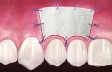 Wie lässt sich der Verlust von befestigtem Zahnfleisch behandeln?