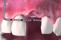 Geistlich Fibro-Gide Die Ausgangssituation zeigt eine Konkavität des Zahnfleischs aufgrund fehlender Zahnfleischdicke.