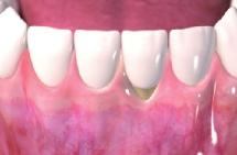 Was passiert bei freiliegenden Zahnwurzeln bzw. Zahnhälsen? Bleiben freiliegende Zahnwurzeln bzw.