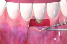 Wurzel-Hypersensibilität, ästhetische oder funktionelle Beeinträchtigungen, Zahnfleischentzündungen, Wurzelkaries und eine beeinträchtigte