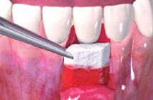 Geistlich Fibro-Gide Ausgangssituation zeigt eine moderat freiliegende Zahnwurzel.