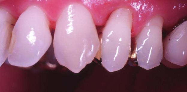 1 2 Gesundes Zahnfleisch ist straff und blutet nicht Gesunde Zähne sind mit einem feinen Wurzelhäutchen überzogen, das mit dem Knochen im