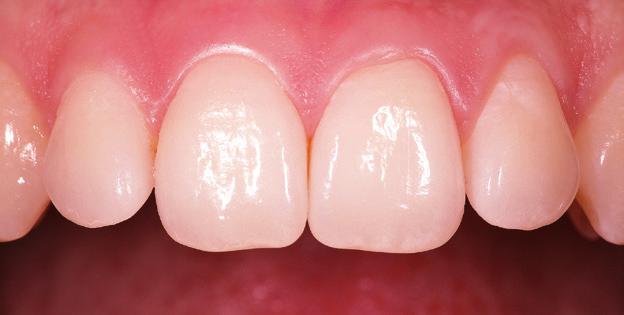 Das Zahnfleisch schwillt an und blutet bei Berührung oder beim Zähneputzen.