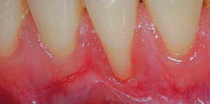 bereits im Wachstum zu Knochenfenstern am Zahnhalteapparat kommen oder die freiliegenden Wurzeloberflächen können Folge von umfangreichen kieferorthopädischen Wurzelbewegungen oder falscher