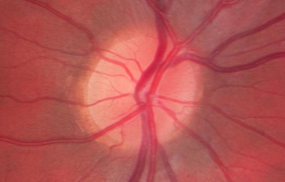 GLAUKOM grüner Star bei denen der Augeninnendruck zu hoch ist acut Galukom chronische Glaukom in der Folge durch eine Schädigung des Sehnervens